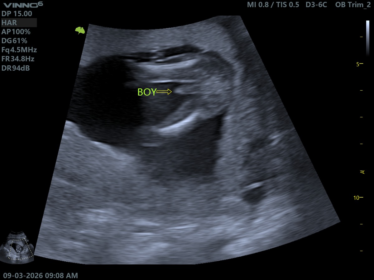 2D Gender Reveal Scan